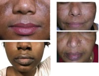 Image 4 of “OMEGA” MALASMA, POST INFLAMMATORY HYPERPIGMENTATION, DARK SPOT POTENT SKIN CORRECTOR 