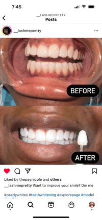 Image 3 of Beaming Smile Advanced Teeth Whitening Gel  “Professional Use Only”