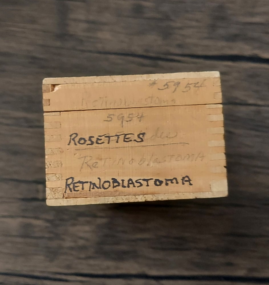 Vintage Medical Slides – Human Eye (Retinoblastimo)