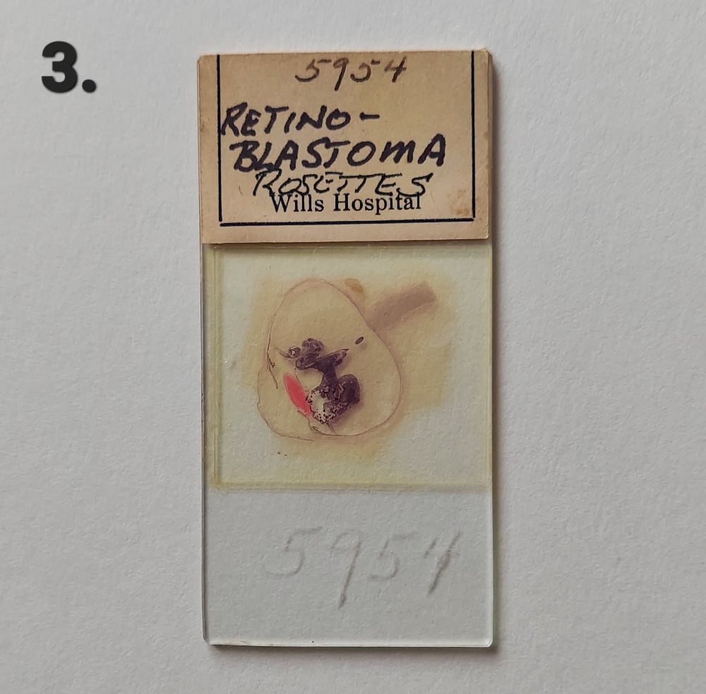 Vintage Medical Slides – Human Eye (Retinoblastimo)