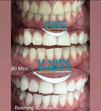 Image 5 of Teeth Whitening Treatments (Tax included)