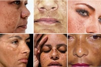 Image 3 of “OMEGA” MALASMA, POST INFLAMMATORY HYPERPIGMENTATION, DARK SPOT POTENT SKIN CORRECTOR 