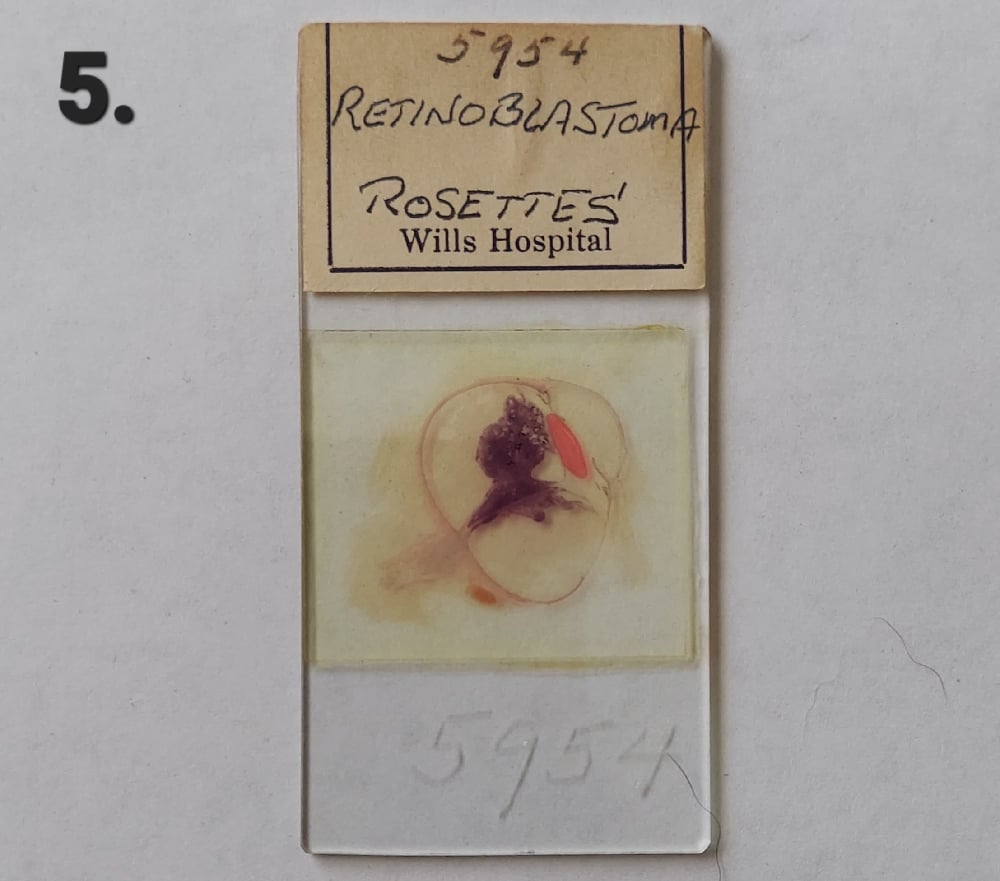 Vintage Medical Slides – Human Eye (Retinoblastimo)