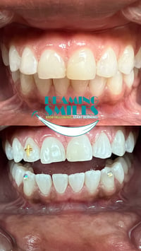 Image 3 of Teeth Whitening + Tooth Gems Specials