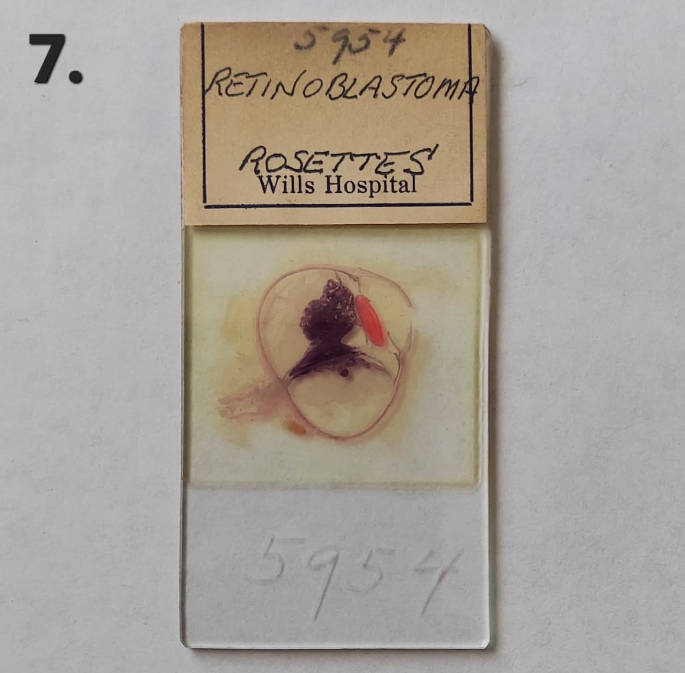Vintage Medical Slides – Human Eye (Retinoblastimo)