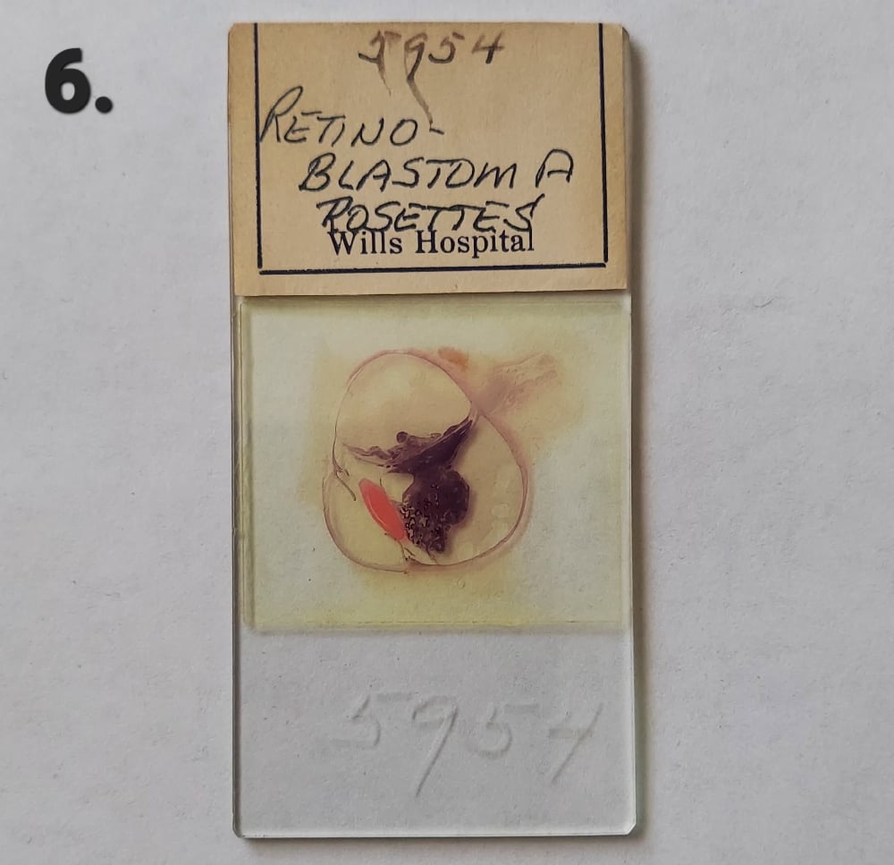 Vintage Medical Slides – Human Eye (Retinoblastimo)