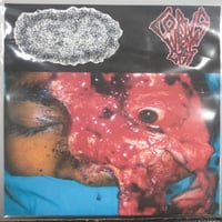 Hydroencephalocystocele / Corpus Luteum Cyst - Split Mini CDr