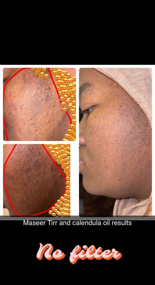 Image of Acne set 2