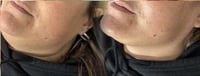 Image 4 of PRESCRIPTA SKIN collagen facial contouring 