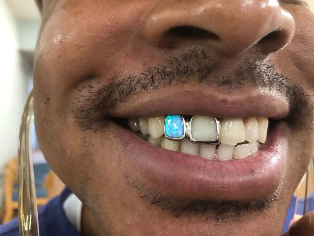 Image of 2 teeth grillz with one Opal 10k yellow gold 