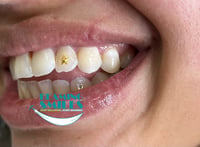 Image 2 of Tooth Gem Services (In Office) Taxes Included