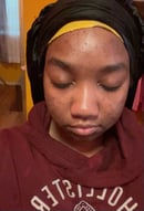 Image 2 of Acne Bundle