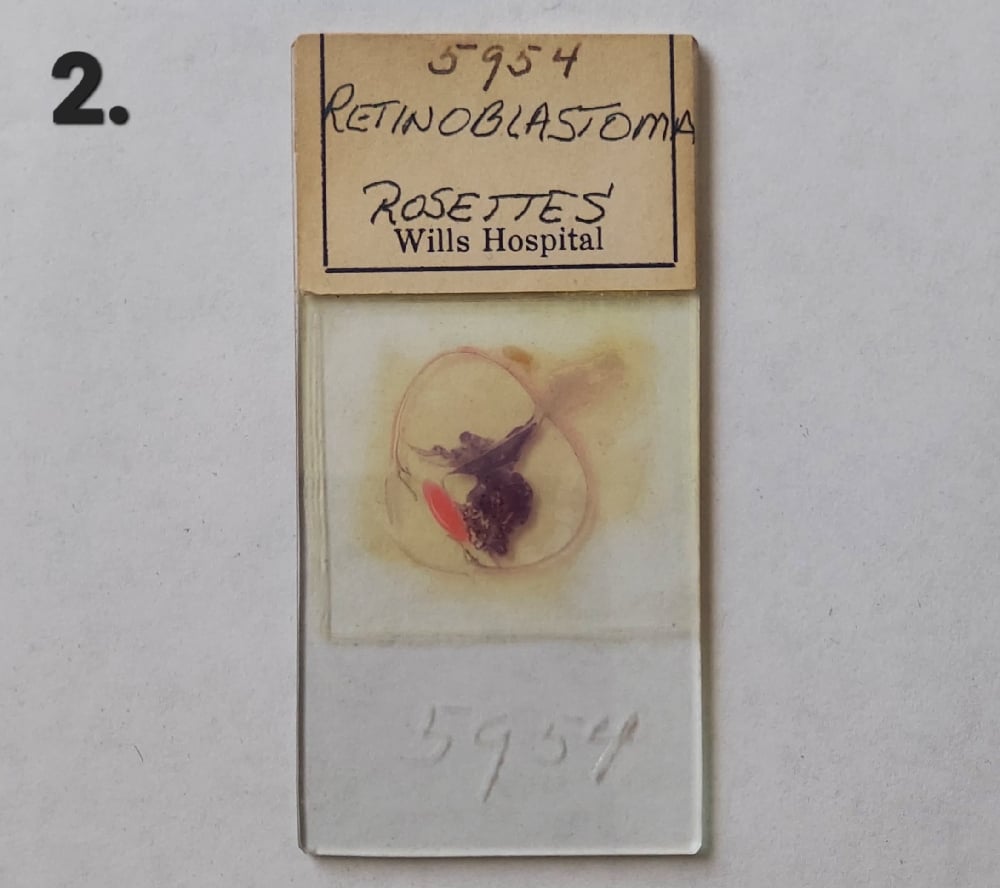 Vintage Medical Slides – Human Eye (Retinoblastimo)