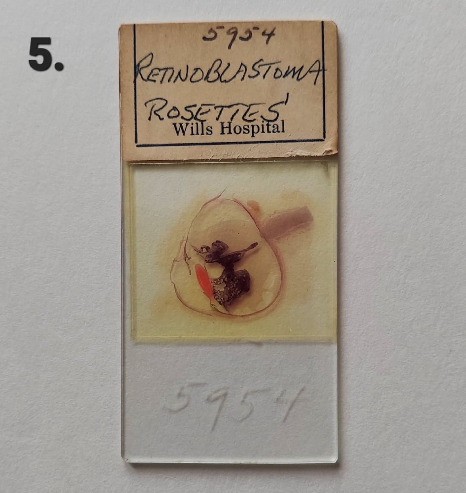 Vintage Medical Slides – Human Eye (Retinoblastimo)