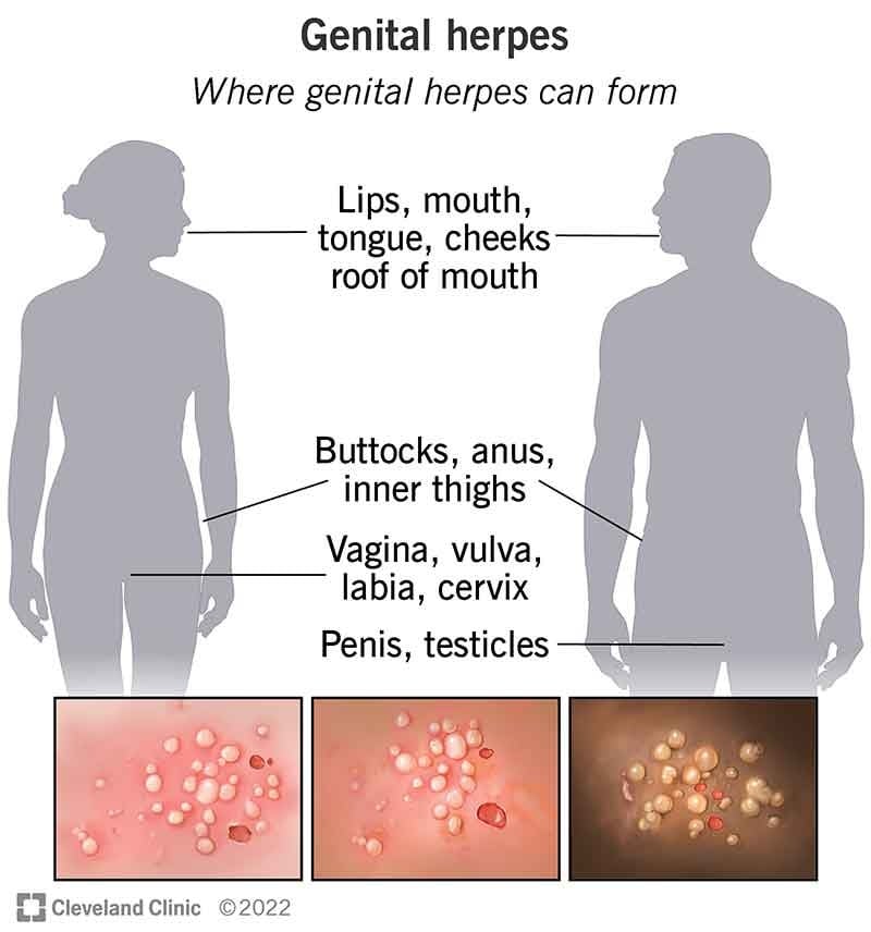 ELDER BERRY BOOST! Elderberries/Elderberry Syrup. Immunity-Herpes-Pathogens-Virus-Cell Protector-