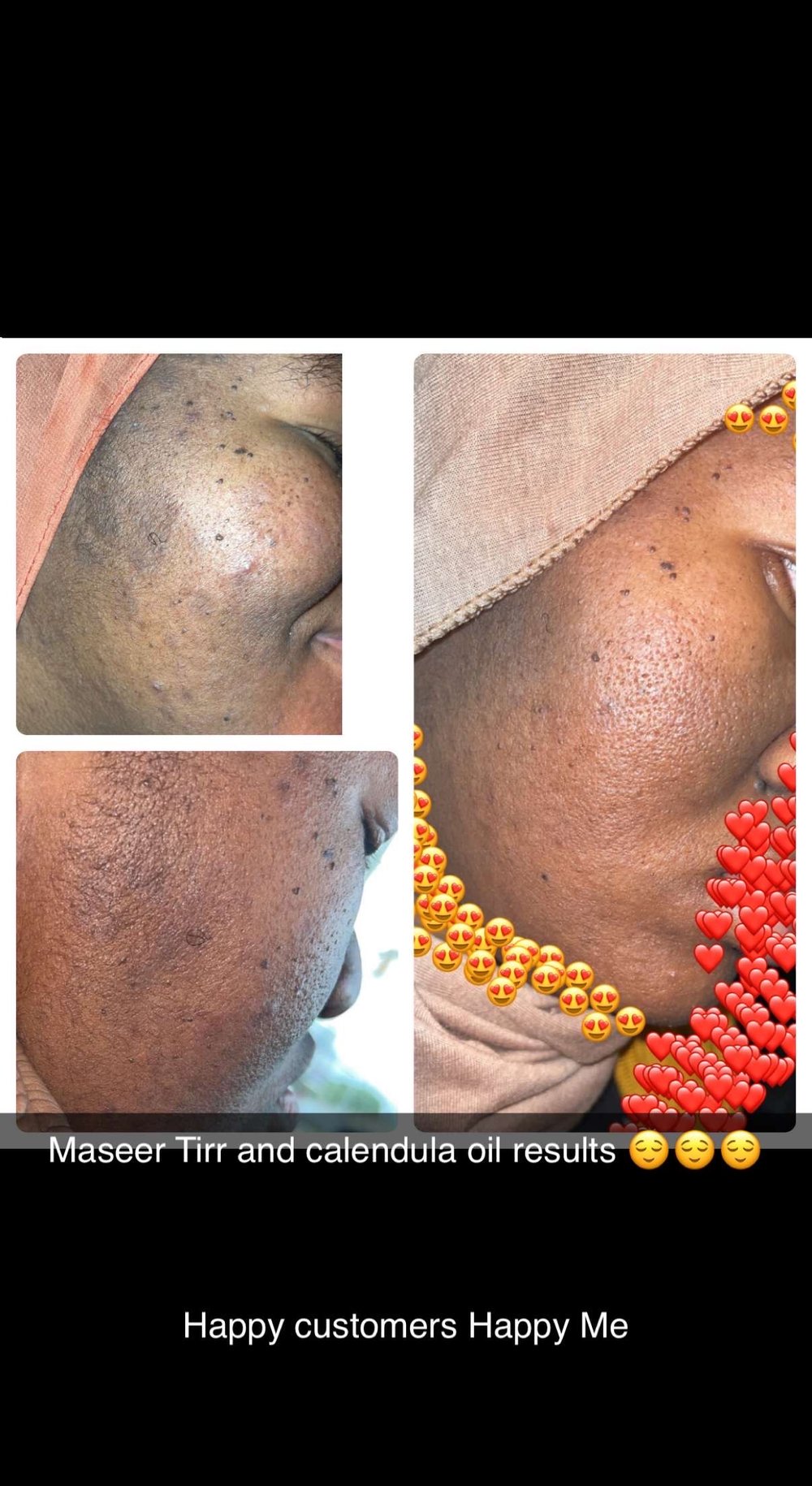 Image of Acne set 2