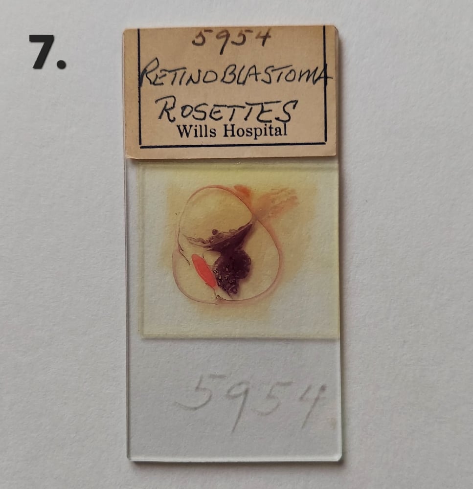 Vintage Medical Slides – Human Eye (Retinoblastimo)