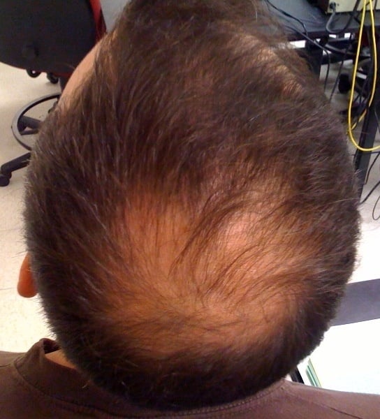 B-A-T-A-N-A Hair/Scalp Nourisher/Regenerator! Hair Loss. Eczema/Acne. Stretch Marks/Scars. UV Rays