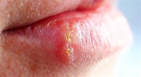 North American Herb & Spice Wild Mediterranean Oregano Oils w/P73. (73%-84% Carvacrol). Herpes.