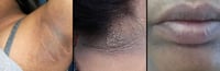Image 7 of  “CLARITY” ACANTHOSIS NIGRICAN (MALASMA) CREAM  
