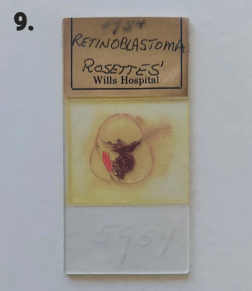 Vintage Medical Slides – Human Eye (Retinoblastimo)