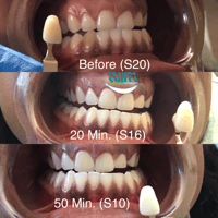 Image 2 of Teeth Whitening Treatments (Tax included)