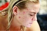 Image 4 of “CLEAR SKIN” ECZEMA, PSORIASIS, ROSACEA, ACNE 