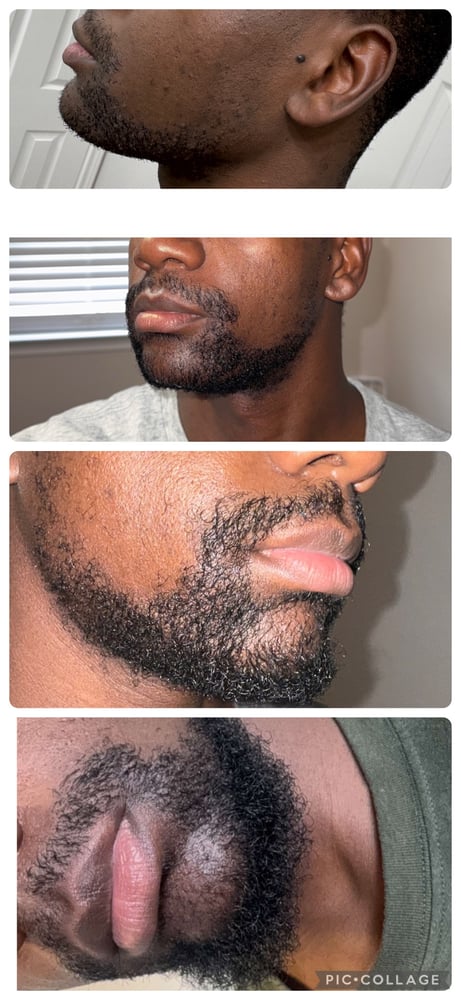 Image of Beard Growth 