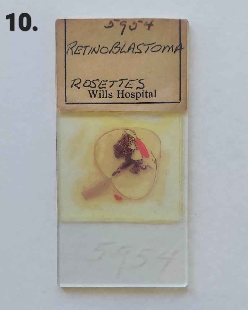 Vintage Medical Slides – Human Eye (Retinoblastimo)