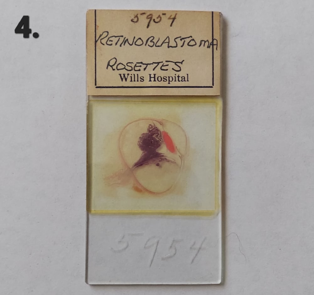 Vintage Medical Slides – Human Eye (Retinoblastimo)